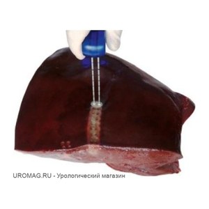 ProSense система минимально инвазивной криотерапии, IceCure Medical, Израиль