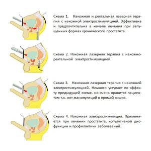Адепт Уролог Оптима - аппарат электролазерной терапии, Россия